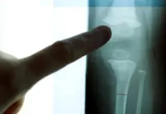صورة توضيحية لهيكل عظمي يظهر خلايا نخاع العظم وتأثيرها على الشيخوخة.